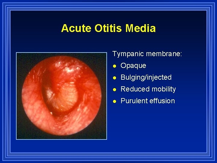 Acute Otitis Media Tympanic membrane: l Opaque l Bulging/injected l Reduced mobility l Purulent