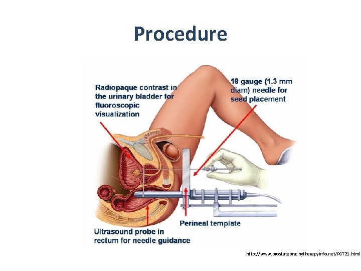 Procedure http: //www. prostatebrachytherapyinfo. net/PCT 21. html 