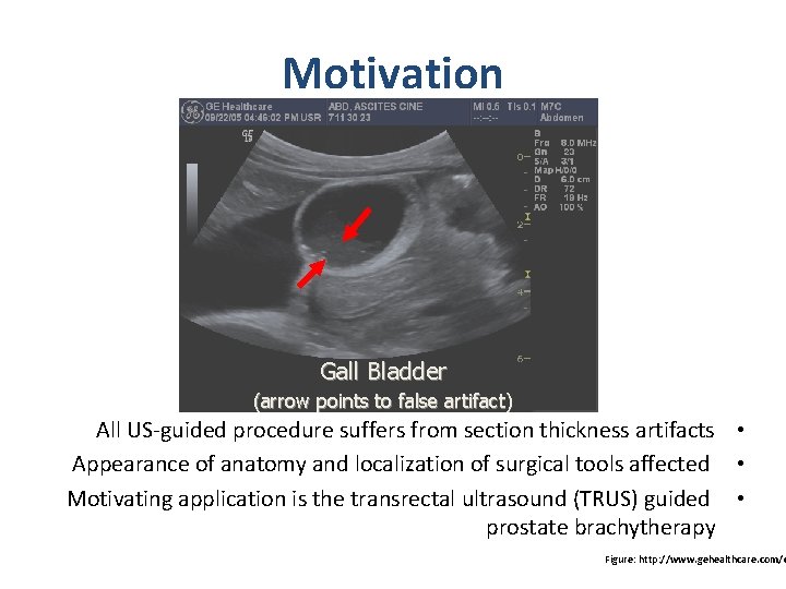 Motivation Gall Bladder (arrow points to false artifact) All US-guided procedure suffers from section