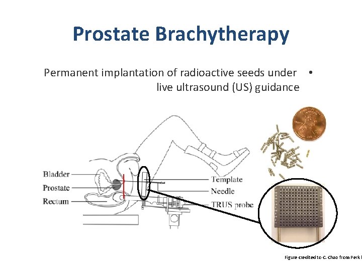 Prostate Brachytherapy Permanent implantation of radioactive seeds under • live ultrasound (US) guidance Figure