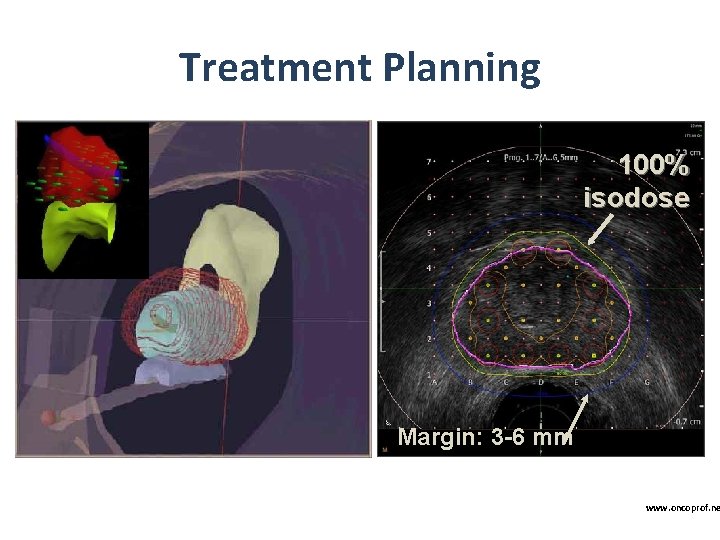 Treatment Planning 100% isodose Margin: 3 -6 mm www. oncoprof. ne 