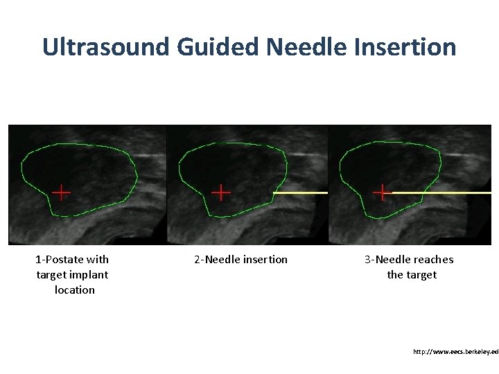 Ultrasound Guided Needle Insertion 1 -Postate with target implant location 2 -Needle insertion 3