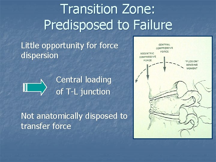 Transition Zone: Predisposed to Failure Little opportunity force dispersion Central loading of T-L junction