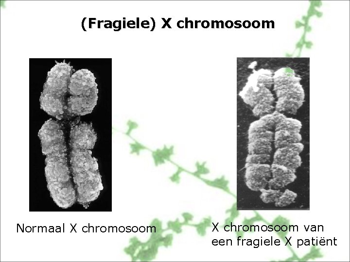 (Fragiele) X chromosoom Normaal X chromosoom van een fragiele X patiënt 
