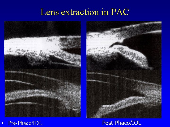 Lens extraction in PAC • Pre-Phaco/IOL Post-Phaco/IOL 