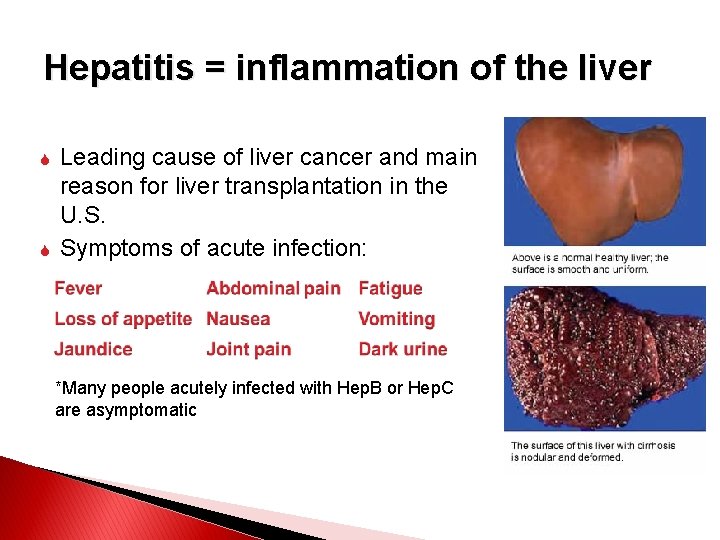 Hepatitis = inflammation of the liver Leading cause of liver cancer and main reason