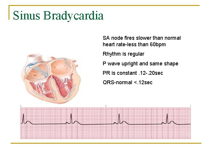 Sinus Bradycardia SA node fires slower than normal heart rate-less than 60 bpm Rhythm