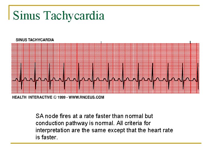 Sinus Tachycardia SA node fires at a rate faster than normal but conduction pathway