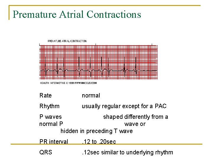 Premature Atrial Contractions Rate normal Rhythm usually regular except for a PAC P waves