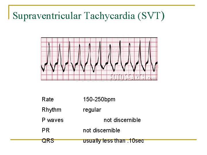 Supraventricular Tachycardia (SVT) Rate 150 -250 bpm Rhythm regular P waves not discernible PR