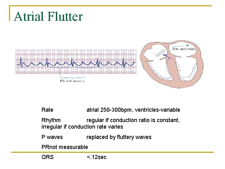 Atrial Flutter Rate atrial 250 -300 bpm, ventricles-variable Rhythm regular if conduction ratio is