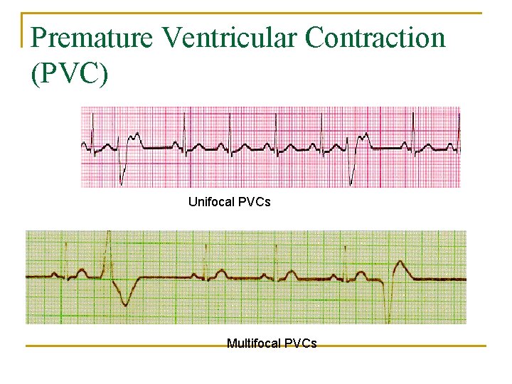 Premature Ventricular Contraction (PVC) Unifocal PVCs Multifocal PVCs 