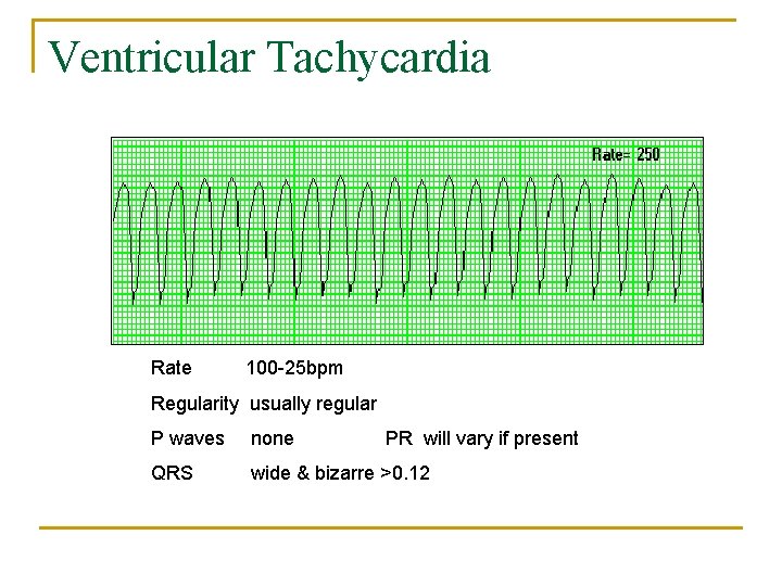 Ventricular Tachycardia Rate 100 -25 bpm Regularity usually regular P waves none PR will