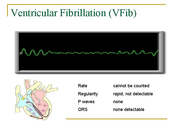 Ventricular Fibrillation (VFib) Rate cannot be counted Regularity rapid, not detectable P waves none