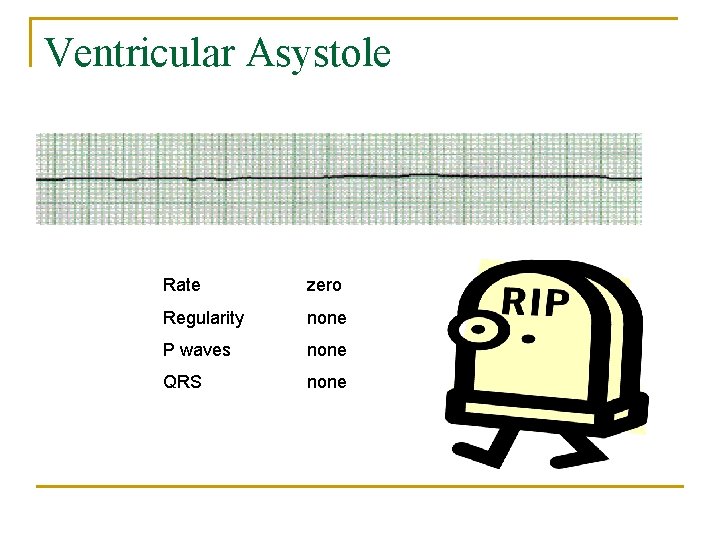 Ventricular Asystole Rate zero Regularity none P waves none QRS none 