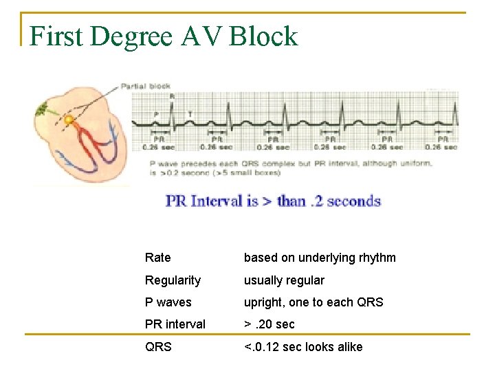 First Degree AV Block Rate based on underlying rhythm Regularity usually regular P waves