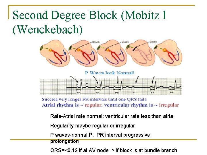 Second Degree Block (Mobitz l (Wenckebach) Rate-Atrial rate normal: ventricular rate less than atria