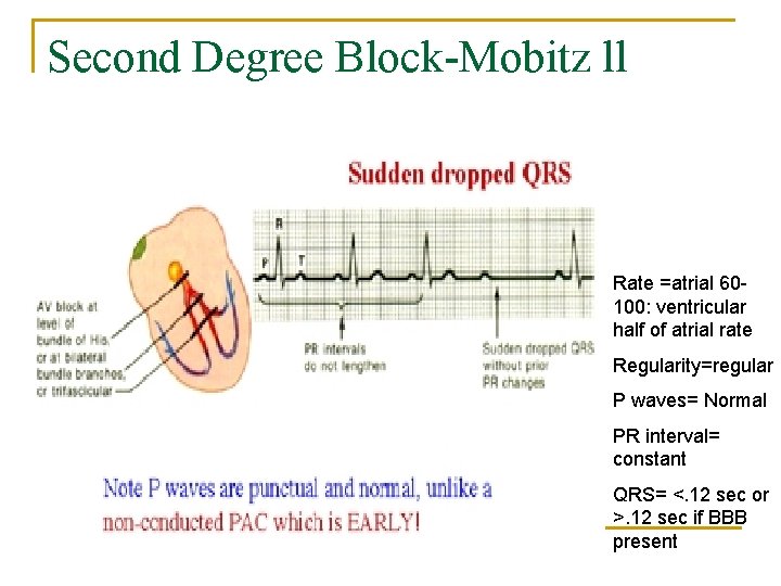 Second Degree Block-Mobitz ll Rate =atrial 60100: ventricular half of atrial rate Regularity=regular P