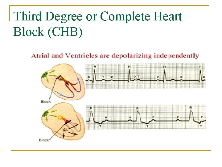 Third Degree or Complete Heart Block (CHB) 
