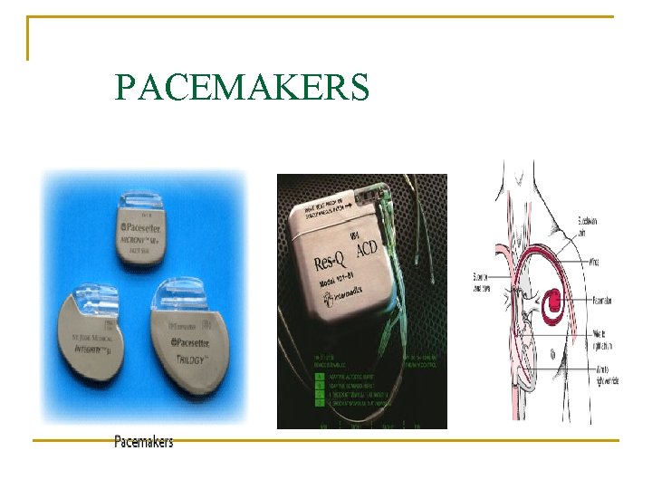 PACEMAKERS 