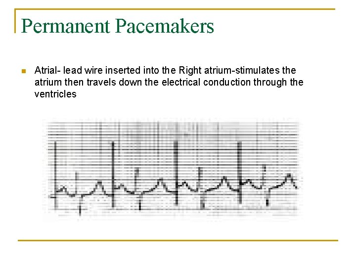 Permanent Pacemakers n Atrial- lead wire inserted into the Right atrium-stimulates the atrium then