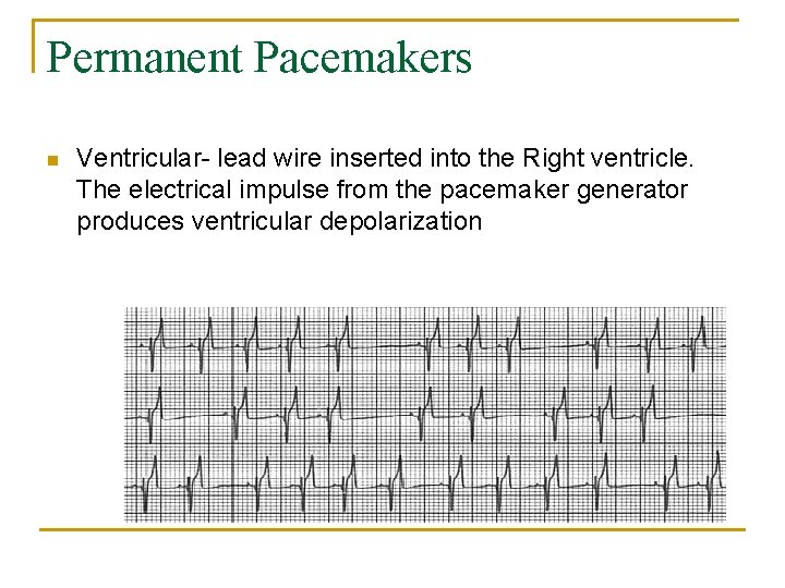 Permanent Pacemakers n Ventricular- lead wire inserted into the Right ventricle. The electrical impulse
