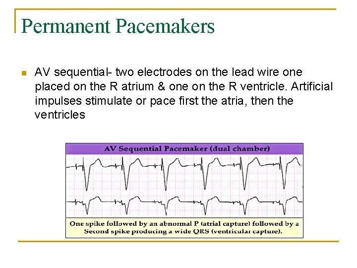 Permanent Pacemakers n AV sequential- two electrodes on the lead wire one placed on