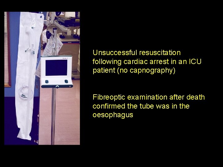 Unsuccessful resuscitation following cardiac arrest in an ICU patient (no capnography) Fibreoptic examination after