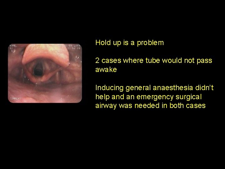 Hold up is a problem 2 cases where tube would not pass awake Inducing