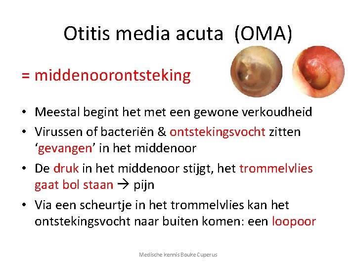 Otitis media acuta (OMA) = middenoorontsteking • Meestal begint het met een gewone verkoudheid