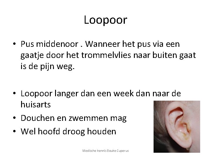 Loopoor • Pus middenoor. Wanneer het pus via een gaatje door het trommelvlies naar