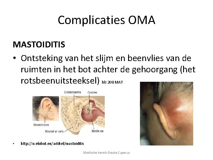 Complicaties OMA MASTOIDITIS • Ontsteking van het slijm en beenvlies van de ruimten in