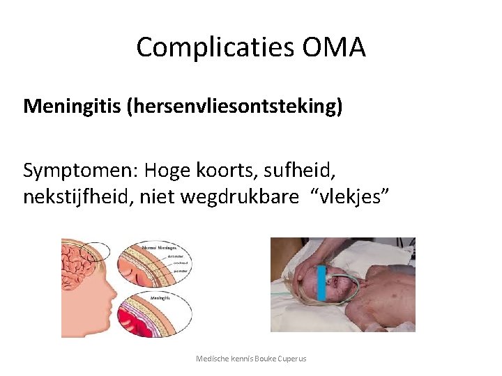 Complicaties OMA Meningitis (hersenvliesontsteking) Symptomen: Hoge koorts, sufheid, nekstijfheid, niet wegdrukbare “vlekjes” Medische kennis