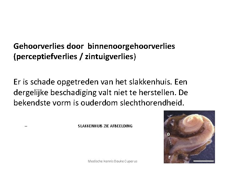 Gehoorverlies door binnenoorgehoorverlies (perceptiefverlies / zintuigverlies) Er is schade opgetreden van het slakkenhuis. Een