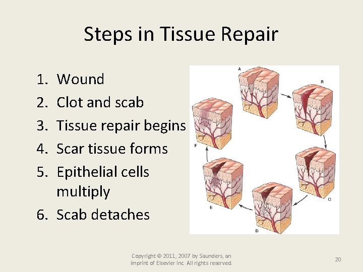 Steps in Tissue Repair 1. 2. 3. 4. 5. Wound Clot and scab Tissue