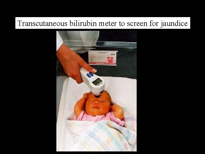 Transcutaneous bilirubin meter to screen for jaundice 
