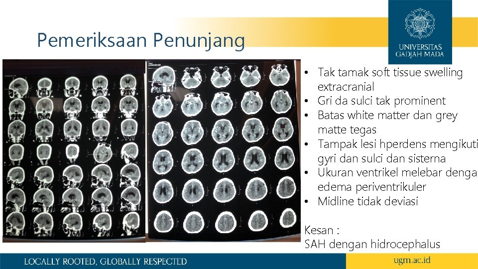 Pemeriksaan Penunjang • Tak tamak soft tissue swelling extracranial • Gri da sulci tak