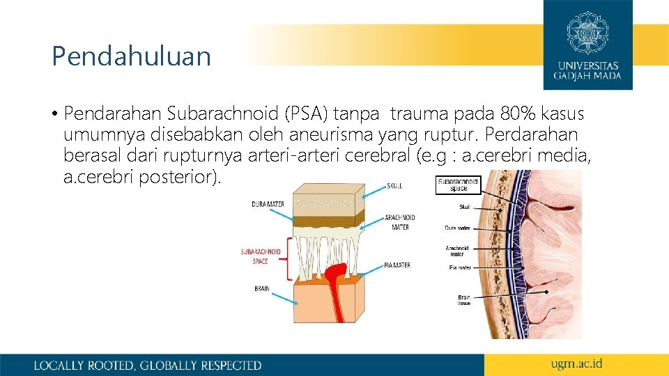 Pendahuluan • Pendarahan Subarachnoid (PSA) tanpa trauma pada 80% kasus umumnya disebabkan oleh aneurisma