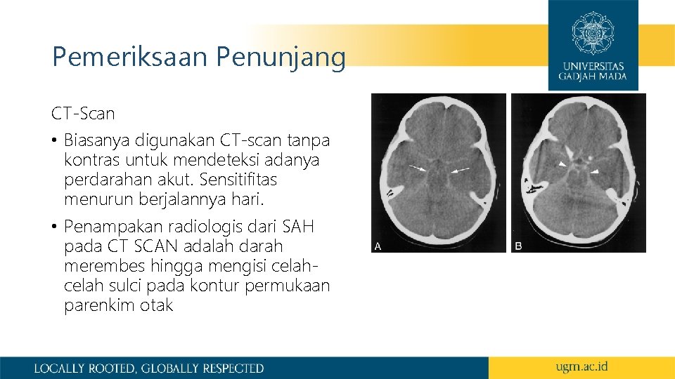 Pemeriksaan Penunjang CT-Scan • Biasanya digunakan CT-scan tanpa kontras untuk mendeteksi adanya perdarahan akut.