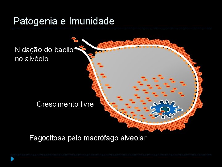 Patogenia e Imunidade Nidação do bacilo no alvéolo Crescimento livre Fagocitose pelo macrófago alveolar