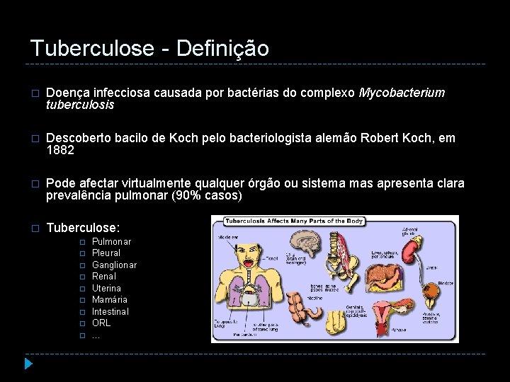 Tuberculose - Definição � Doença infecciosa causada por bactérias do complexo Mycobacterium tuberculosis �