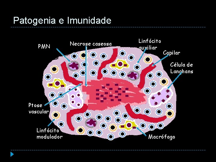 Patogenia e Imunidade PMN Necrose caseosa Linfócito auxiliar Capilar Célula de Langhans Ptose vascular