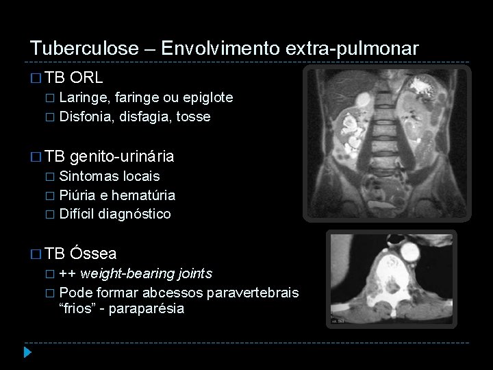 Tuberculose – Envolvimento extra-pulmonar � TB ORL Laringe, faringe ou epiglote � Disfonia, disfagia,