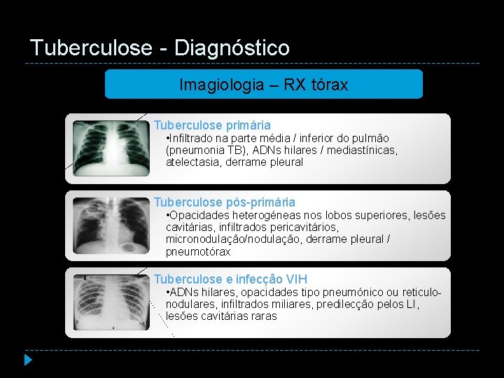 Tuberculose - Diagnóstico Imagiologia – RX tórax Tuberculose primária • Infiltrado na parte média