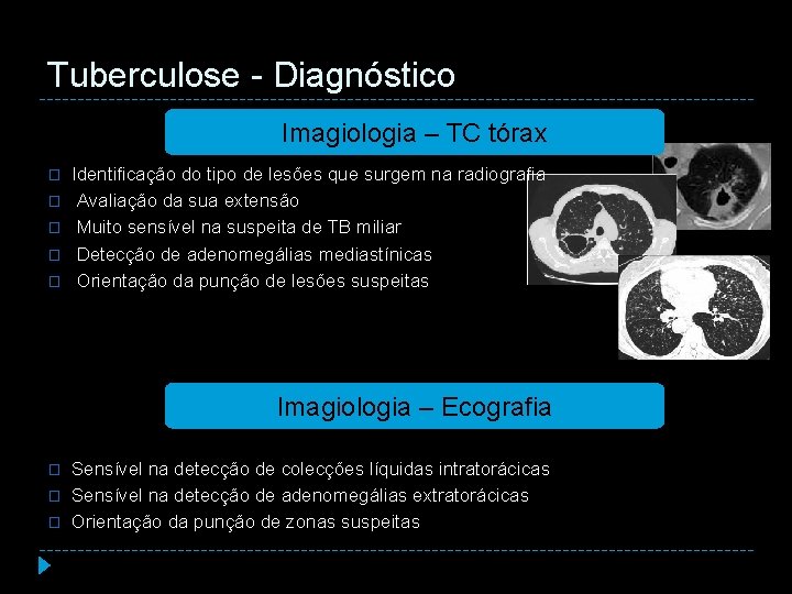 Tuberculose - Diagnóstico Imagiologia – TC tórax � � � Identificação do tipo de