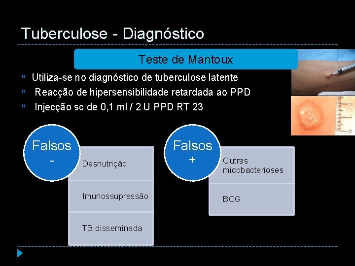 Tuberculose - Diagnóstico Teste de Mantoux Utiliza-se no diagnóstico de tuberculose latente Reacção de