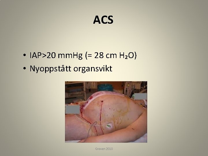 ACS • IAP>20 mm. Hg (= 28 cm H₂O) • Nyoppstått organsvikt Groven 2010