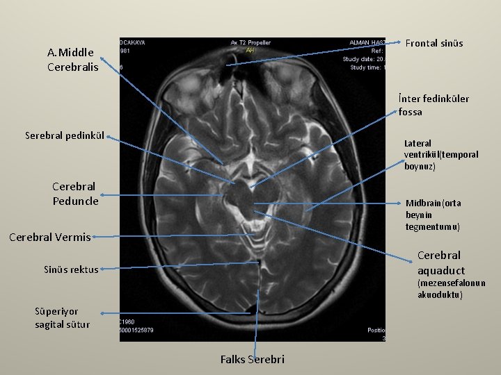 Frontal sinüs A. Middle Cerebralis İnter fedinküler fossa Serebral pedinkül Lateral ventrikül(temporal boynuz) Cerebral