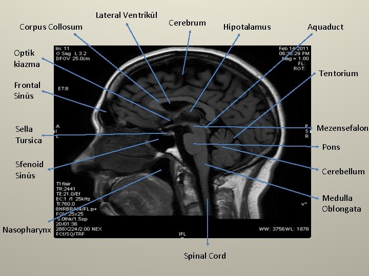 Lateral Ventrikül Corpus Collosum Cerebrum Hipotalamus Optik kiazma Aquaduct Tentorium Frontal Sinüs Mezensefalon Sella