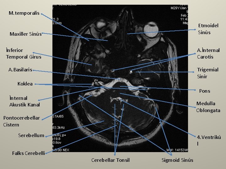 M. temporalis Maxiller Sinüs Etmoidel Sinüs İnferior Temporal Girus A. İnternal Carotis A. Basilaris